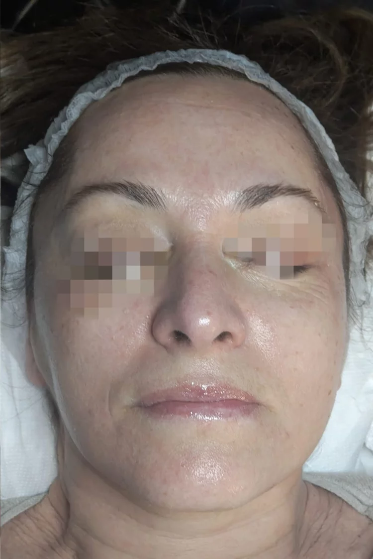 Risultato dopo il trattamento Dermapen con incarnato uniforme e luminoso