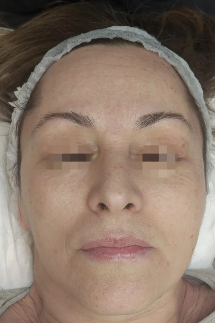 Risultato prima del trattamento Dermapen