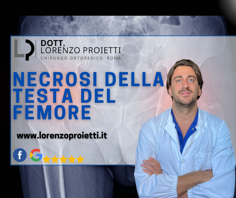 necrosi testa femore