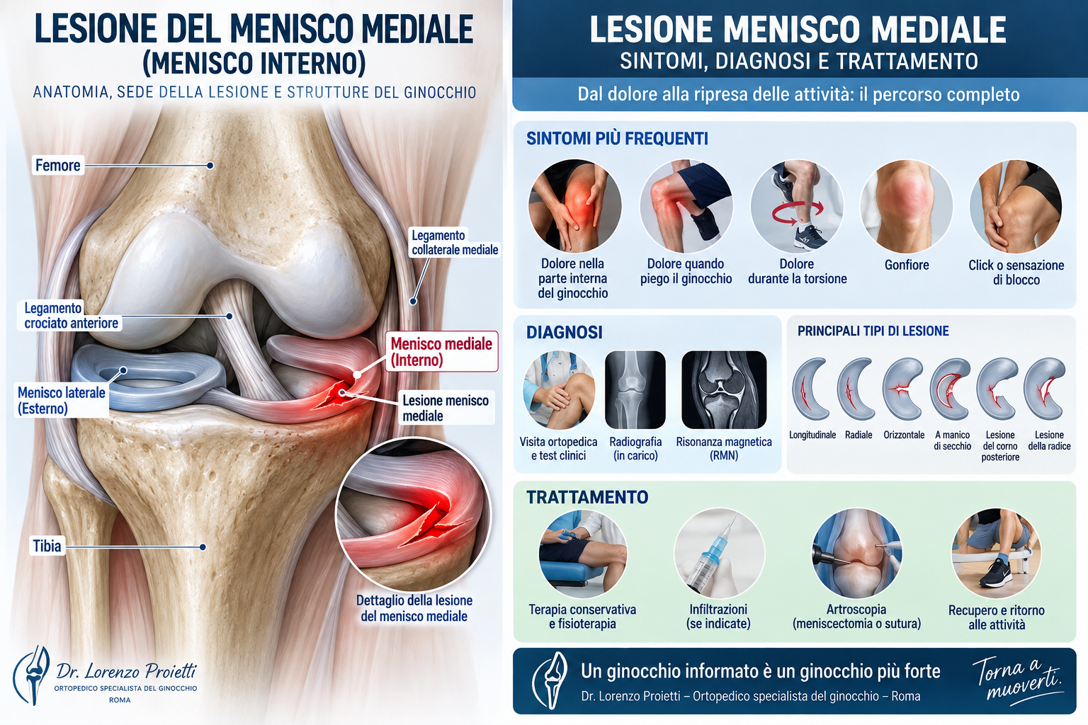 lesione menisco interno