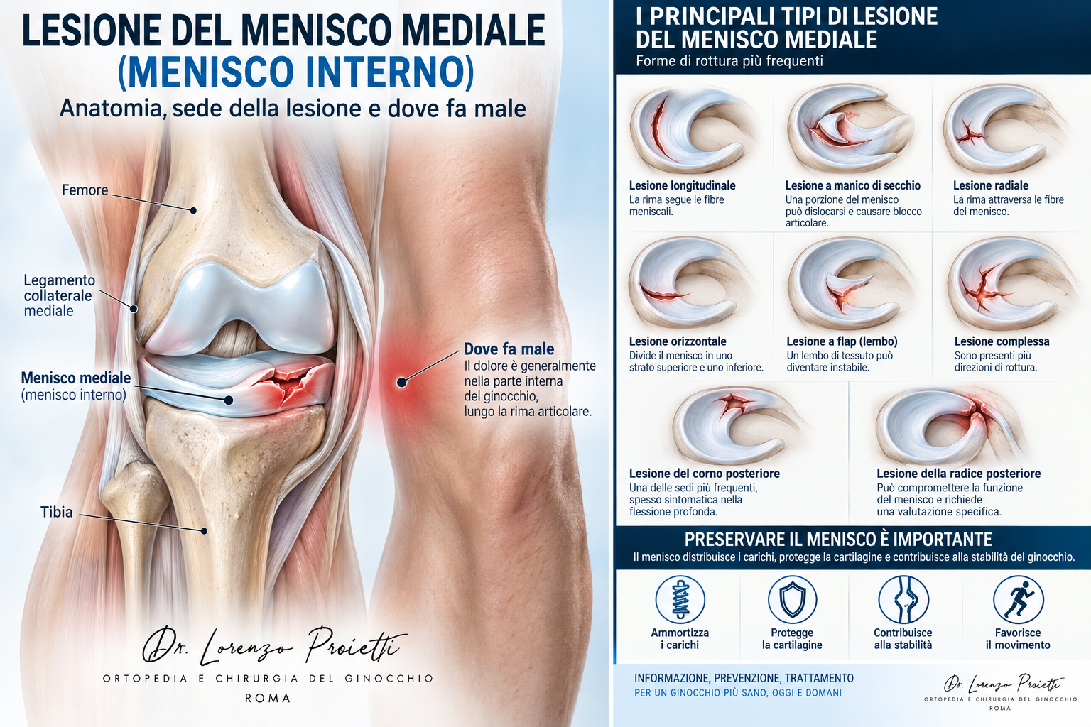lesione menisco mediale