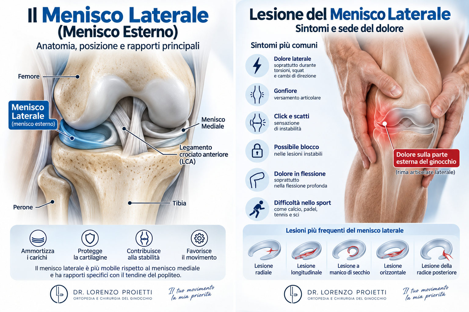 lesione menisco esterno roma