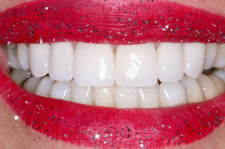 faccette applicate e sbiancamento.jpeg