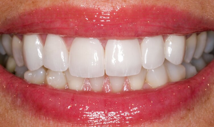 faccette visione frontale.jpeg