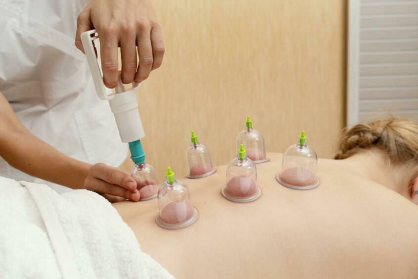 Trattamento di Cupping therapy o Coppettazione