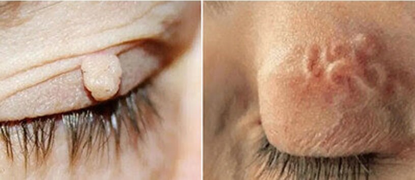 parasite-papillomas.jpeg parasite-papillomas.jpeg