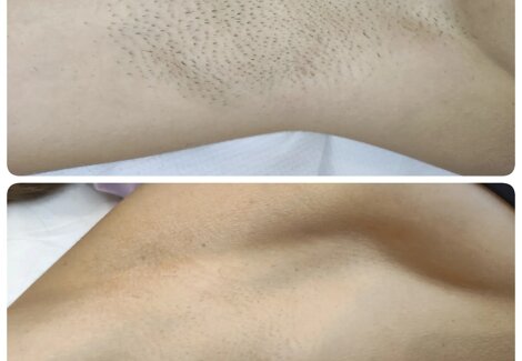 Epilazione laser, immagine prima e dopo il trattamento
