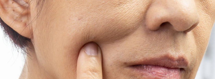 Pelle secca in inverno: perch&eacute; il freddo causa pelle che tira e rossori (routine viso completa)