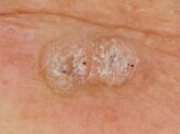 scatto polarizzato dermatologia (2).jpeg