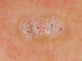 scatto polarizzato dermatologia (3).jpeg