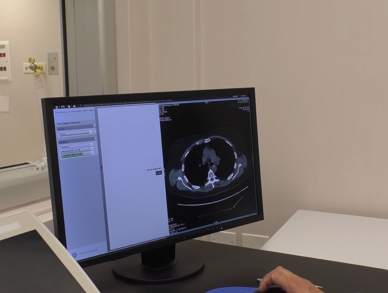 Tumore al polmone, gli esiti del programma RISP Diagnosticati tumori e inviati pazienti ai centri antifumo