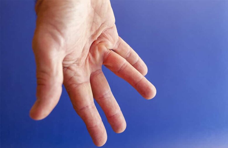 morbo-di-dupuytren-alla-mano.jpeg