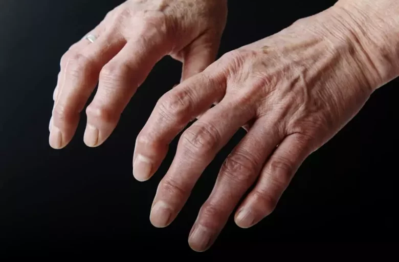 artrosi-alle-mani-1024x672