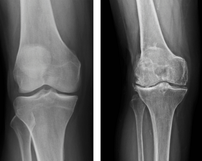 ginocchio-onartrosi ginocchio-onartrosi