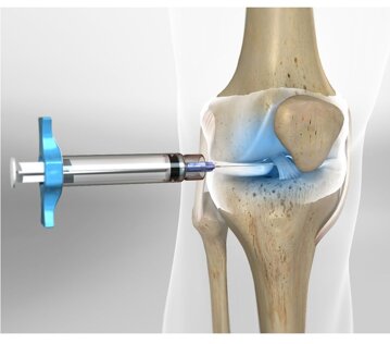 kneeinject_1280.jpeg kneeinject_1280.jpeg