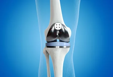 knee-replacement_1_(533623)-min