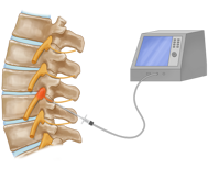 pulsed_radiofrequency_treatment_opt pulsed_radiofrequency_treatment_opt