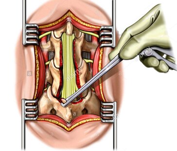 l4-e-l5-laminectomia-c86r4d.jpeg l4-e-l5-laminectomia-c86r4d.jpeg