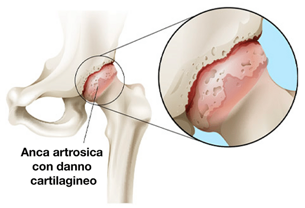 artrosi-danca artrosi-danca