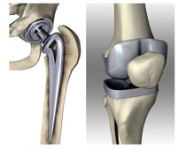protesis_cadera_rodilla-1.jpeg protesis_cadera_rodilla-1.jpeg