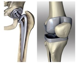 protesis_cadera_rodilla-1.jpeg protesis_cadera_rodilla-1.jpeg