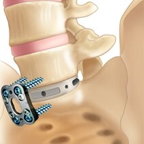 lumbar-plate-with-spacer-and-screws.jpeg lumbar-plate-with-spacer-and-screws.jpeg