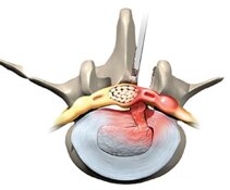understanding-lumbar-disc-prolapse-and-lumbar-discectomy-5.jpeg understanding-lumbar-disc-prolapse-and-lumbar-discectomy-5.jpeg