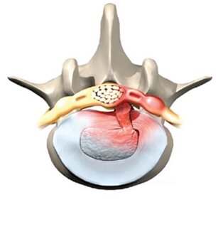 ernia del disco.jpeg