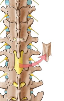 laminectomy.jpeg laminectomy.jpeg