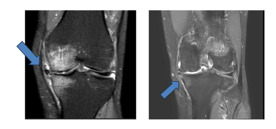 artrosi-ginocchio-risonanza-magnetica artrosi-ginocchio-risonanza-magnetica