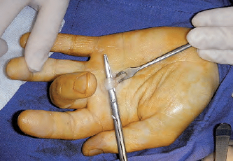 figura-1-tenolisis-convencional-a-cielo-abierto figura-1-tenolisis-convencional-a-cielo-abierto