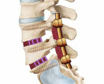 artrodesi_vertebrale_2.jpeg artrodesi_vertebrale_2.jpeg