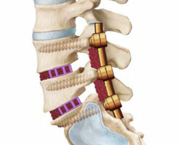 artrodesi_vertebrale_2.jpeg artrodesi_vertebrale_2.jpeg