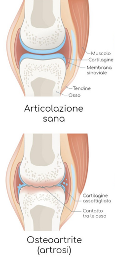 artrosi_vert artrosi_vert