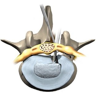 lumbar_discectomy_intro01.jpeg lumbar_discectomy_intro01.jpeg