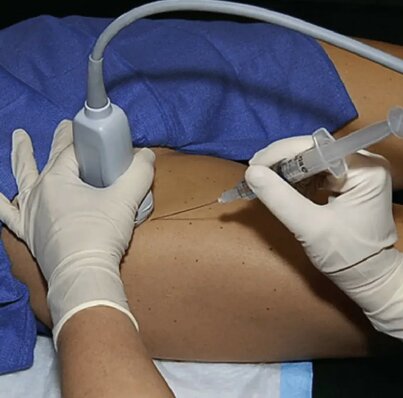 infiltrazione-ecoguidata.jpeg infiltrazione-ecoguidata.jpeg