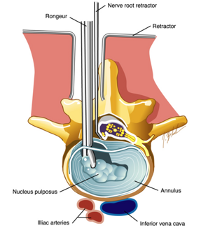 varma-mis-microdiscectomy-animation