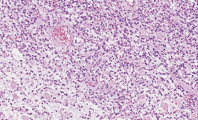 round-epithelioid cell mfb- soft tissue.jpeg