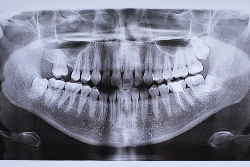 un-immagine-di-una-mascella-con-un-dente-impiantato.jpeg