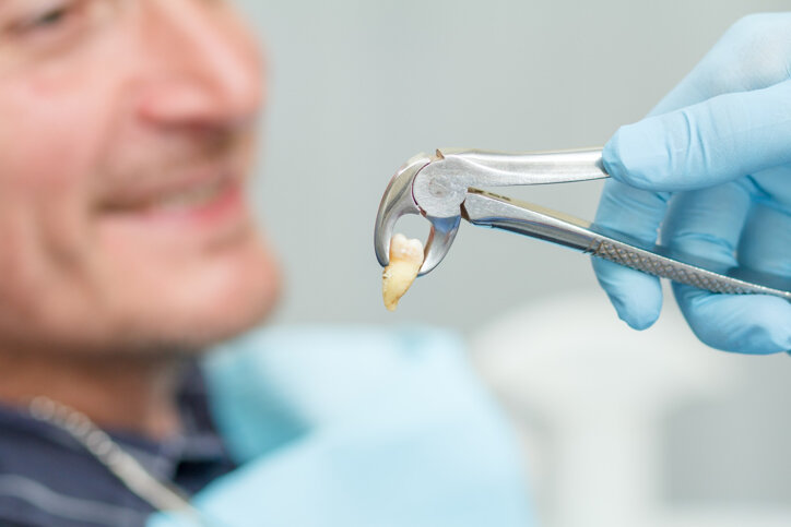 Chirurgia orale estrazioni dentali Chirurgia orale estrazioni dentali