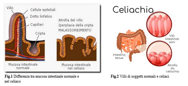 celiachia.png