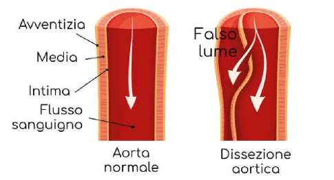 aorta.png