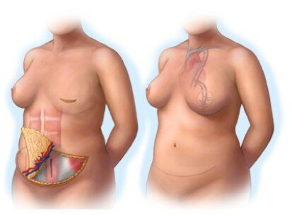 A Catania nuove tecniche per la ricostruzione mammaria e la riduzione del linfedema A Catania nuove tecniche per la ricostruzione mammaria e la riduzione del linfedema