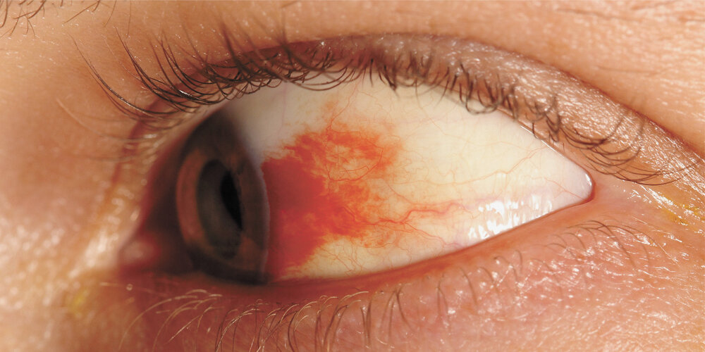 Prevenzione della retinopatia diabetica al Policlinico di Catania
