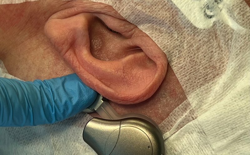 Palermo, dispositivo auricolare per trattare l'ipoacusia