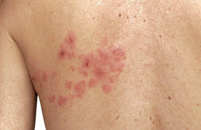 L&rsquo;herpes zoster infiamma i vasi sanguigni e provoca infarto