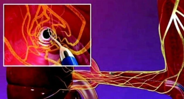 A Taormina denervazione renale per l&rsquo;ipertensione resistente