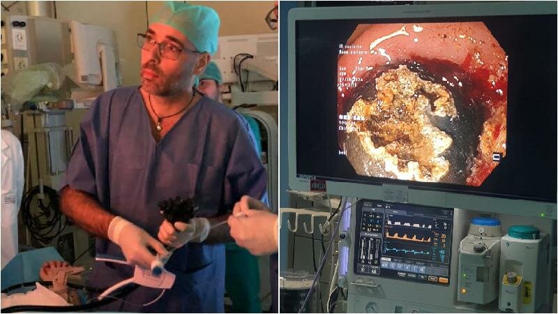 Sindrome di Bouveret, al Garibaldi intervento unico al mondo Sindrome di Bouveret, al Garibaldi intervento unico al mondo