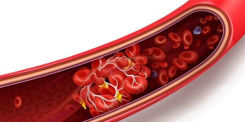 Ictus, a Siracusa un nuovo sistema per fronteggiarlo