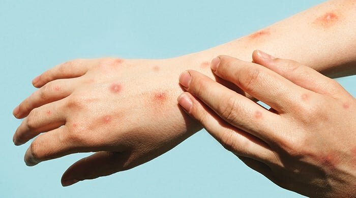 Estate da paura tra Covid e vaiolo delle scimmie